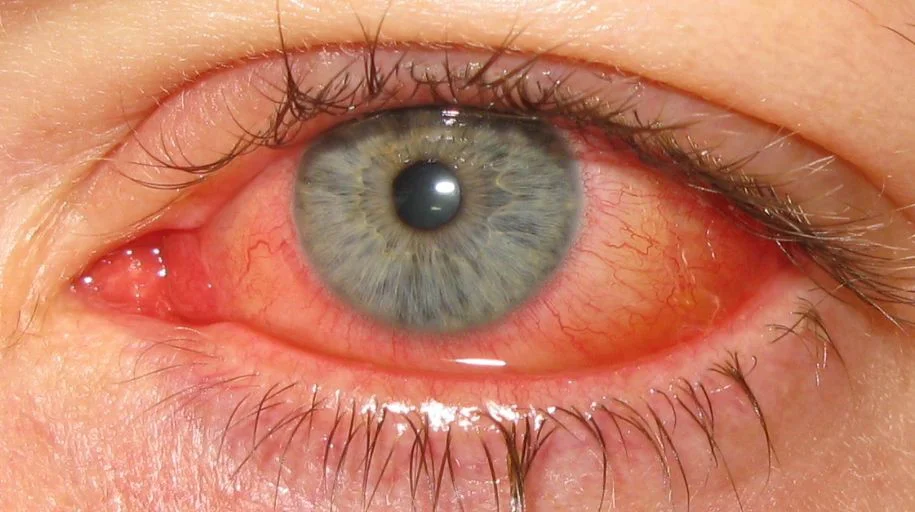آدنوویروس انسانی (Adenoviral Conjunctivitis)