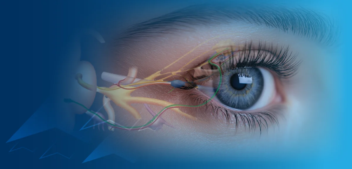 بررسی پیشرفت پیرچشمی در بیماران مبتلا به گلوکومِ تحت درمان با آگونیست‌های گیرندهٔ پروستاگلاندین F (FP)